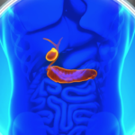 Ilustração do sistema digestivo com destaque para a vesícula biliar e formação de cálculos biliares.