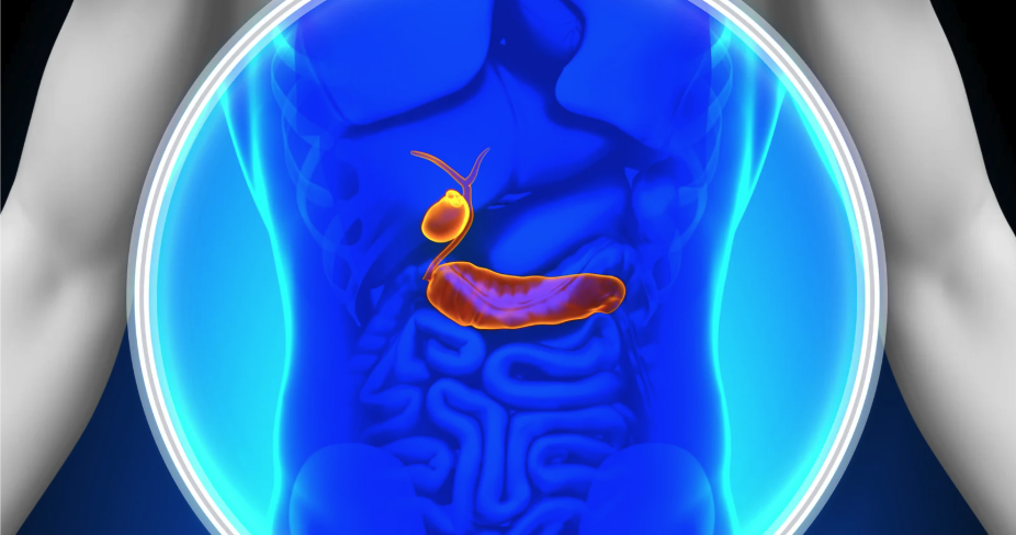 Ilustração do sistema digestivo com destaque para a vesícula biliar e formação de cálculos biliares.